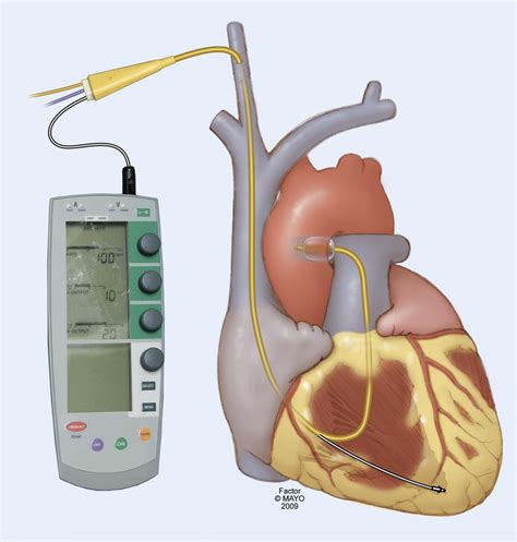 rapid ventricular pacing